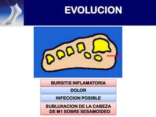 BURSITIS INFLAMATORIA
DOLOR
INFECCION POSIBLE
SUBLUXACION DE LA CABEZA
DE M1 SOBRE SESAMOIDEO

 