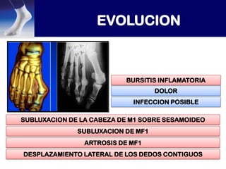 BURSITIS INFLAMATORIA
DOLOR
INFECCION POSIBLE
SUBLUXACION DE LA CABEZA DE M1 SOBRE SESAMOIDEO
SUBLUXACION DE MF1
ARTROSIS DE MF1
DESPLAZAMIENTO LATERAL DE LOS DEDOS CONTIGUOS

 
