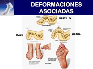 MARTILLO

MAZO

GARRA

 