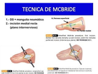 1.- DS + manguito neumático.
2.- incisión medial recta
(plano internervioso)

N. Peroneo superficial

N. Plantar medial

 