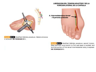 LIBERACION DEL TENDON ADUCTOR Y DE LA
PORCION LATERAL DE LA CAPSULA

A. Intermetatarsiana dorsal
– N peroneo profundo

 
