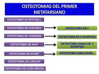 OSTEOTOMIA DE MITCHELL
OSTEOTOMIA DE CHEVRON
OSTEOTOMIA DE JHONSON
OSTEOTOMIA DE AKIN

OSTEOTOMIA DE SCARF
OSTEOTOMIA DE LUDLOFF

OSTEOTOMIA DE CUÑA MEDIAL

 