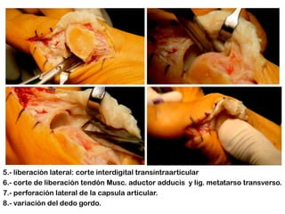 5.- liberación lateral: corte interdigital transintraarticular
6.- corte de liberación tendón Musc. aductor adducis y lig. metatarso transverso.
7.- perforación lateral de la capsula articular.
8.- variación del dedo gordo.

 