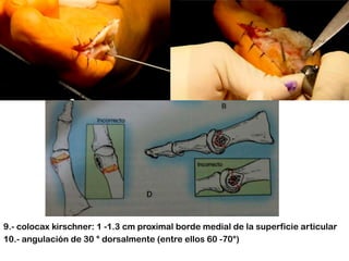 9.- colocax kirschner: 1 -1.3 cm proximal borde medial de la superficie articular
10.- angulación de 30 ° dorsalmente (entre ellos 60 -70°)

 