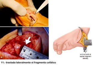 11.- traslada lateralmente el fragmento cefálico

 
