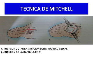 1.- INCISION CUTANEA (INSICION LONGITUDINAL MEDIAL)
2.- INCISION DE LA CAPSULA EN Y

 