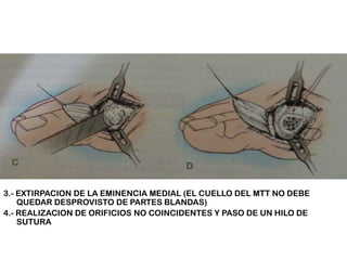 3.- EXTIRPACION DE LA EMINENCIA MEDIAL (EL CUELLO DEL MTT NO DEBE
QUEDAR DESPROVISTO DE PARTES BLANDAS)
4.- REALIZACION DE ORIFICIOS NO COINCIDENTES Y PASO DE UN HILO DE
SUTURA

 