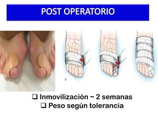  Inmovilización ~ 2 semanas
 Peso según tolerancia

 