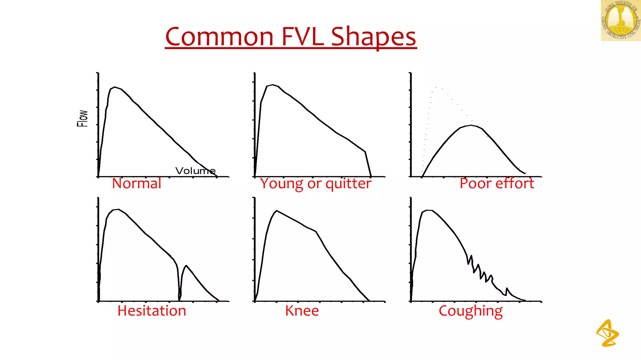 Common FVL Shapes
Normal Young or quitter Poor effort
Hesitation Knee Coughing
 