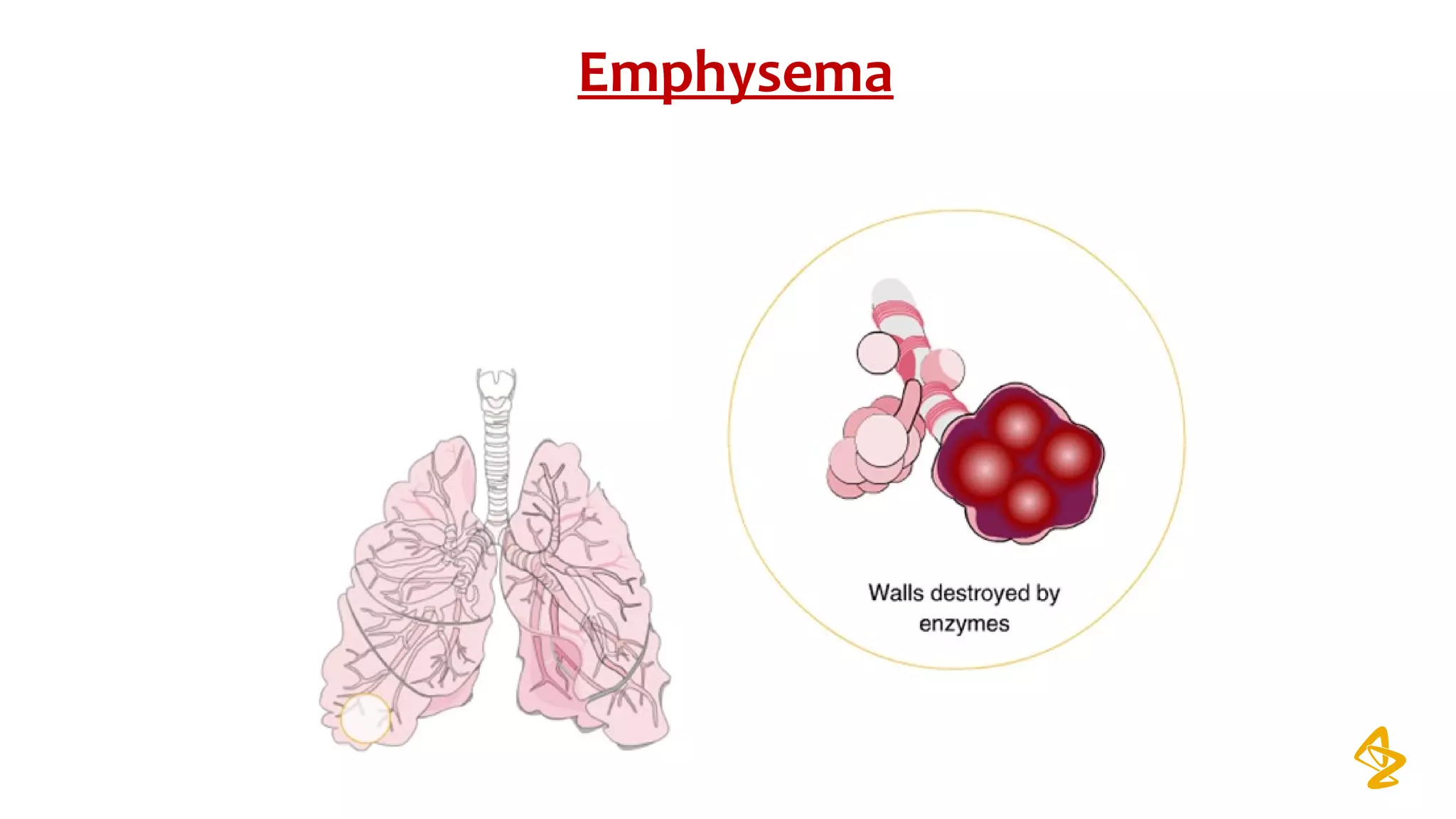 Emphysema
 