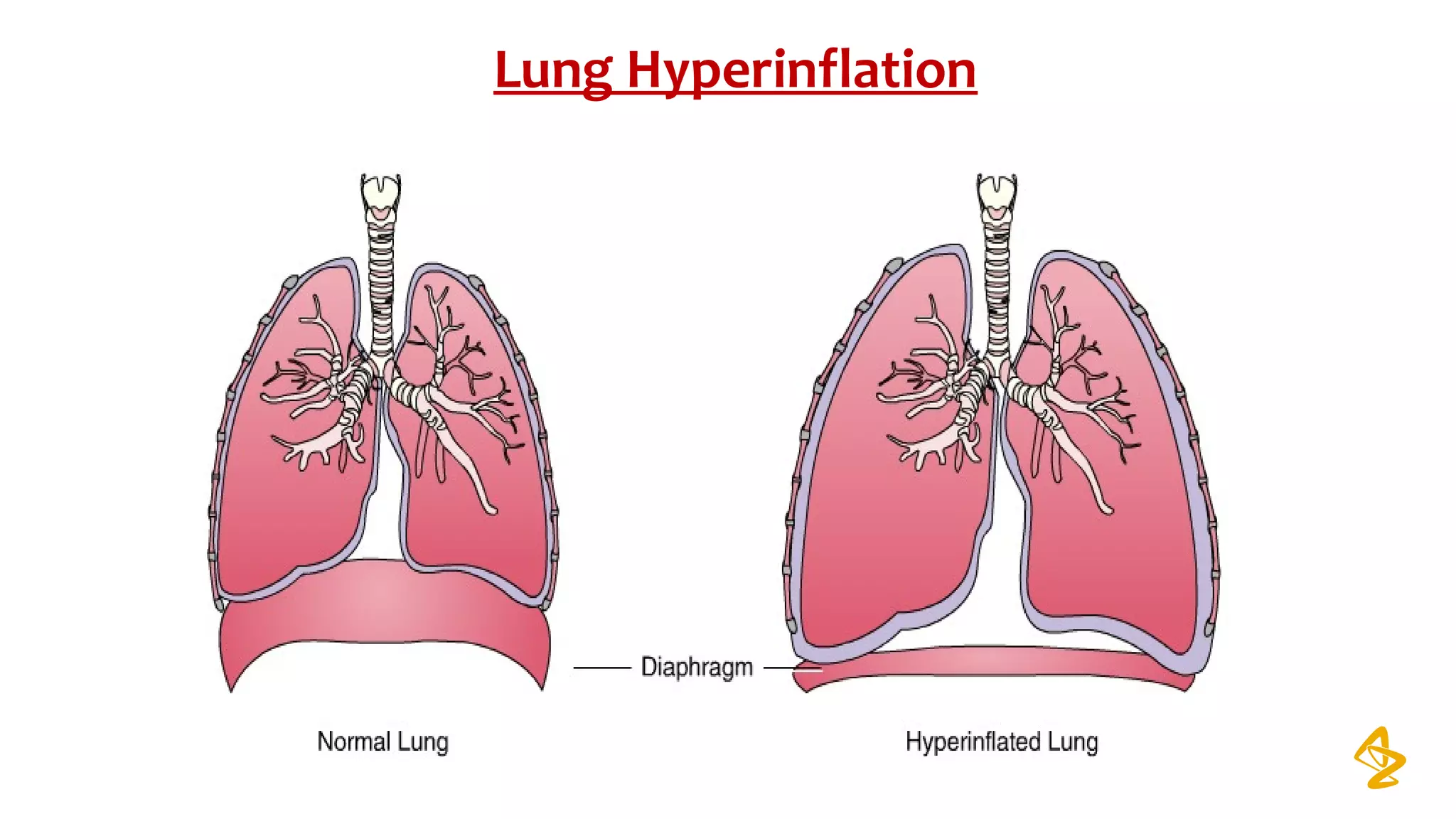 Lung Hyperinflation
 