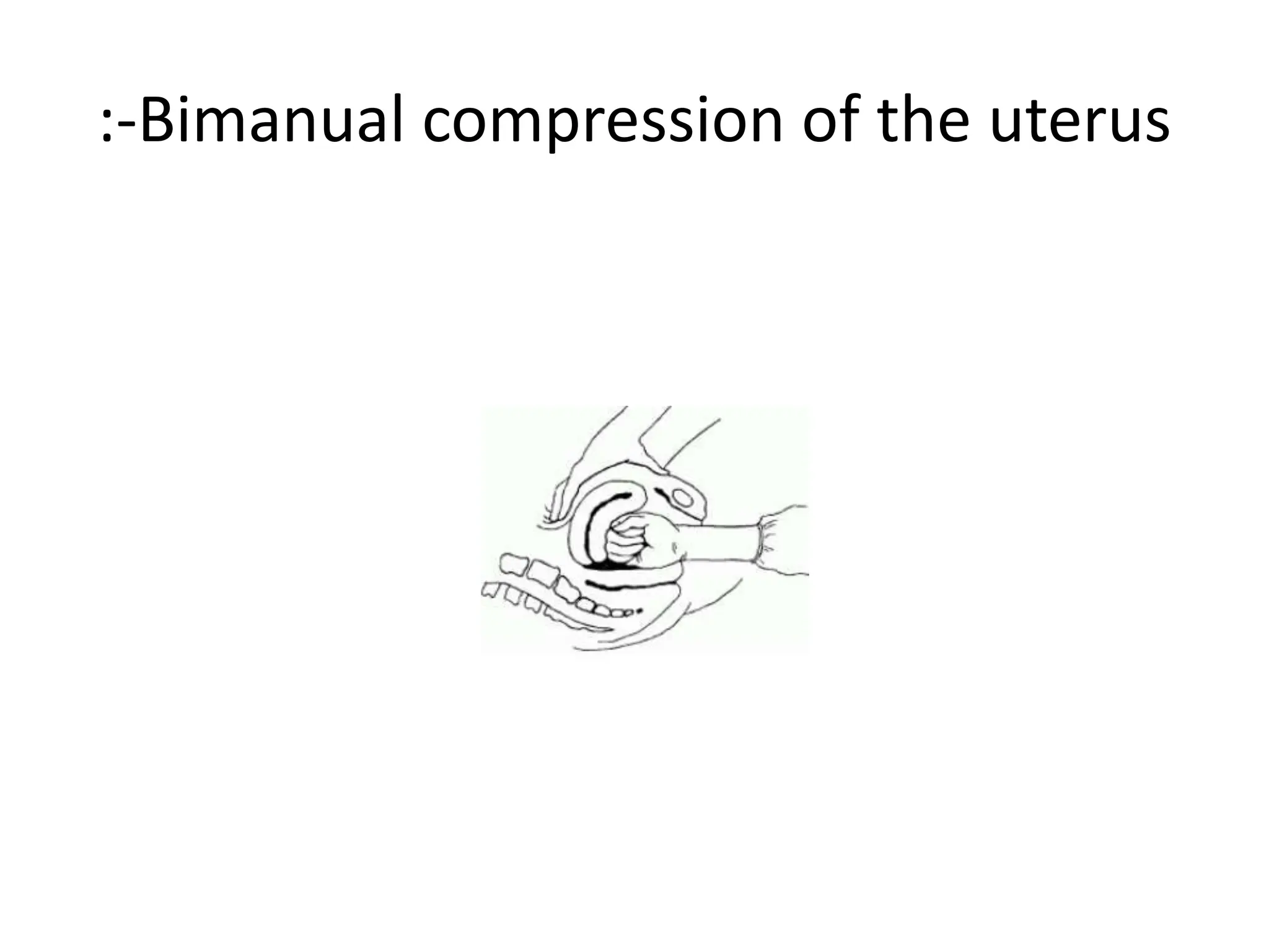 :-Bimanual compression of the uterus
 