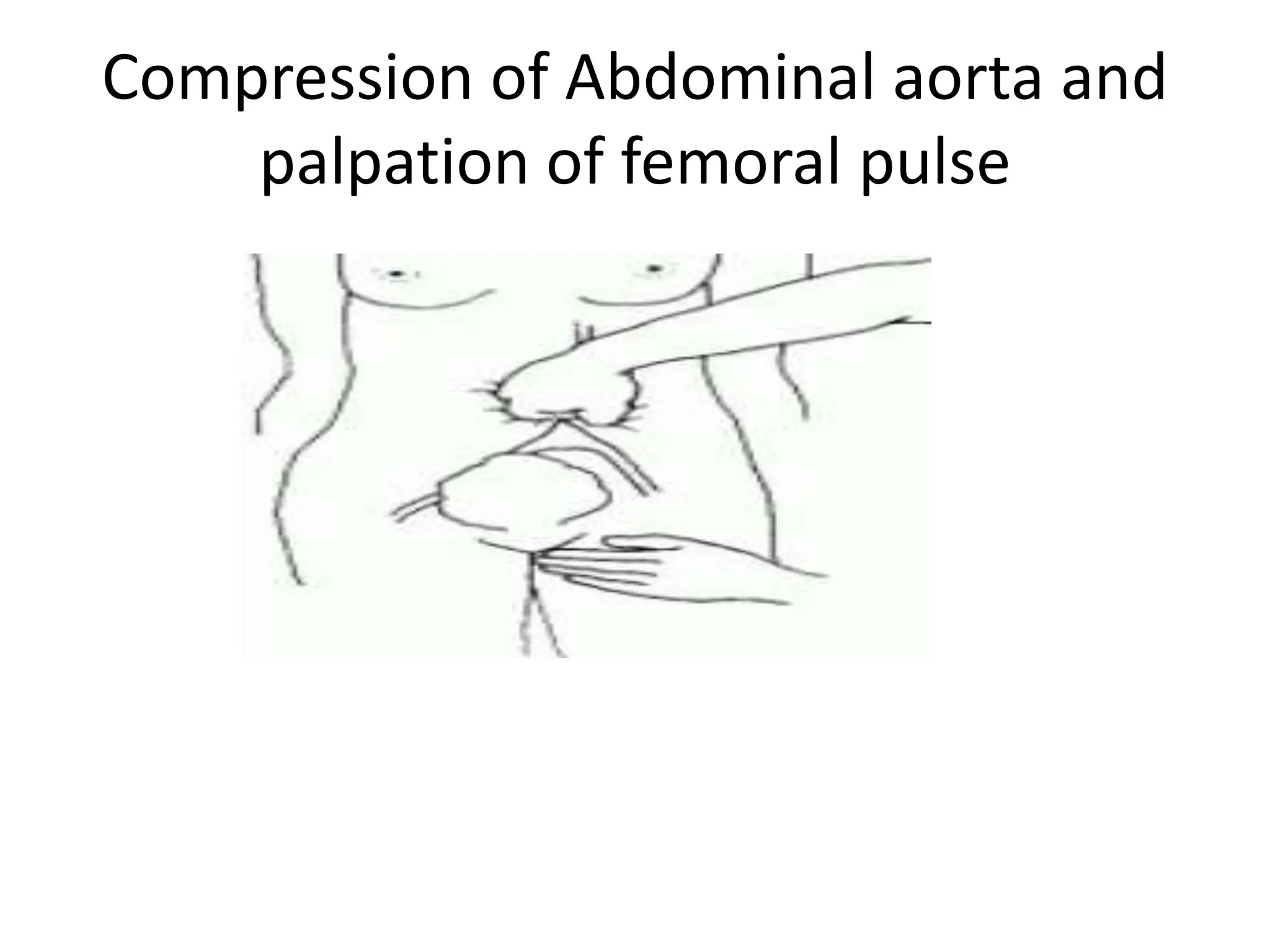 Compression of Abdominal aorta and
palpation of femoral pulse
 