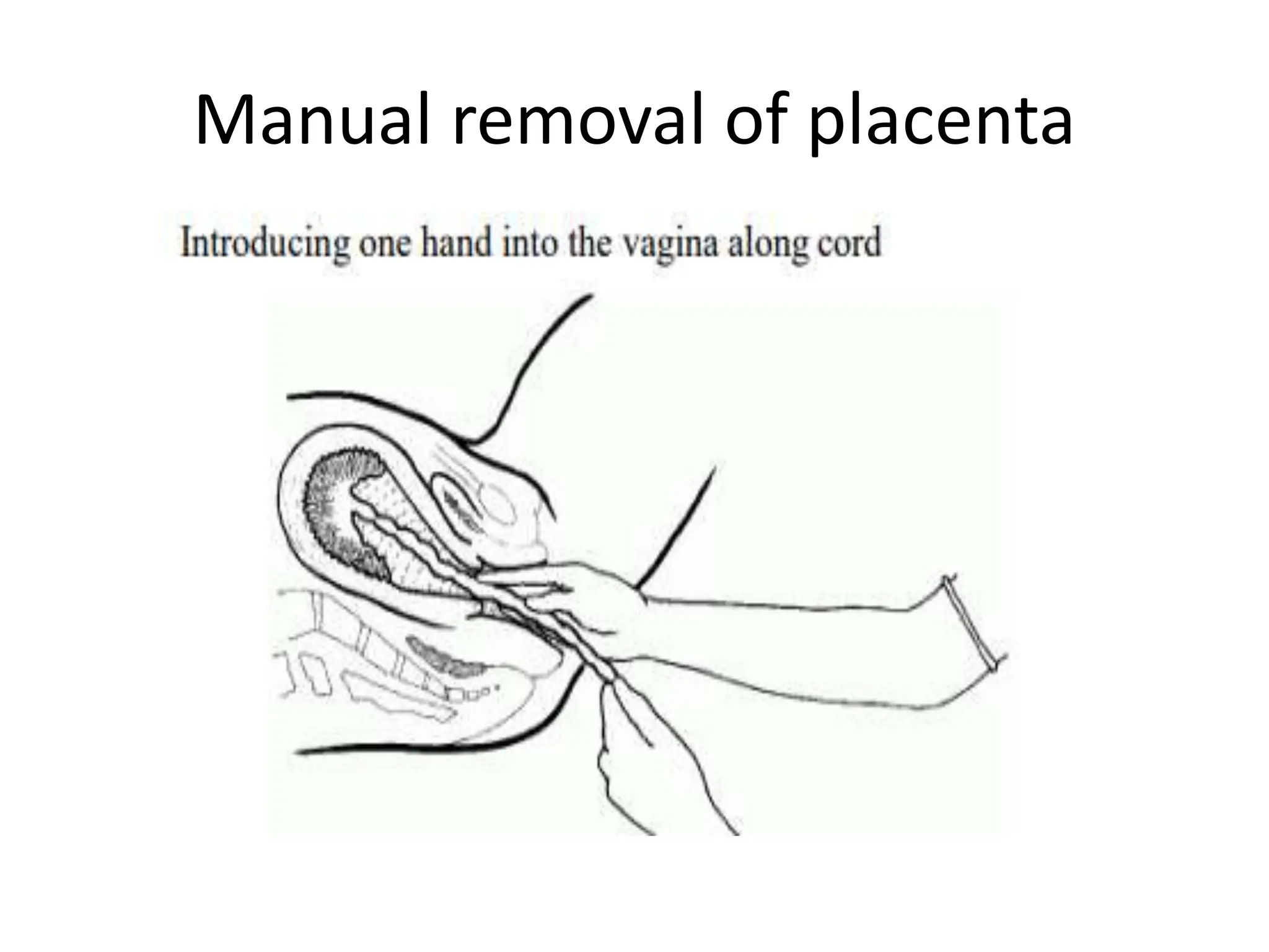Manual removal of placenta
 