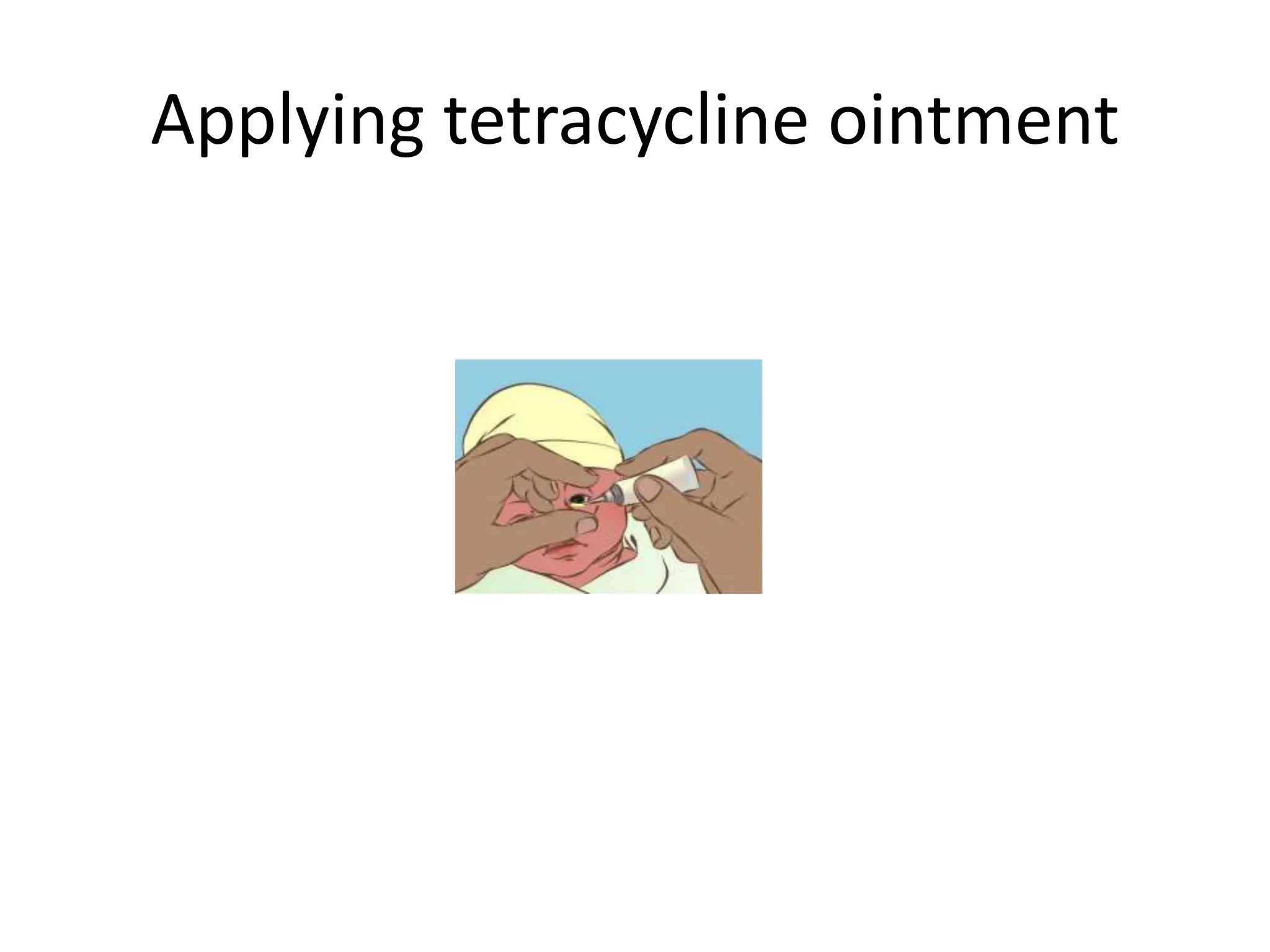 Applying tetracycline ointment
 