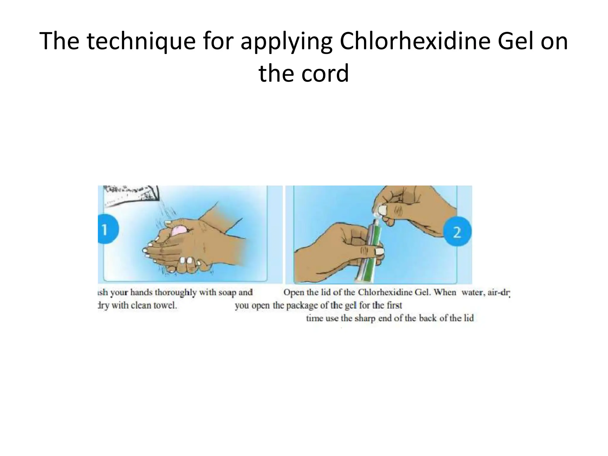 The technique for applying Chlorhexidine Gel on
the cord
 