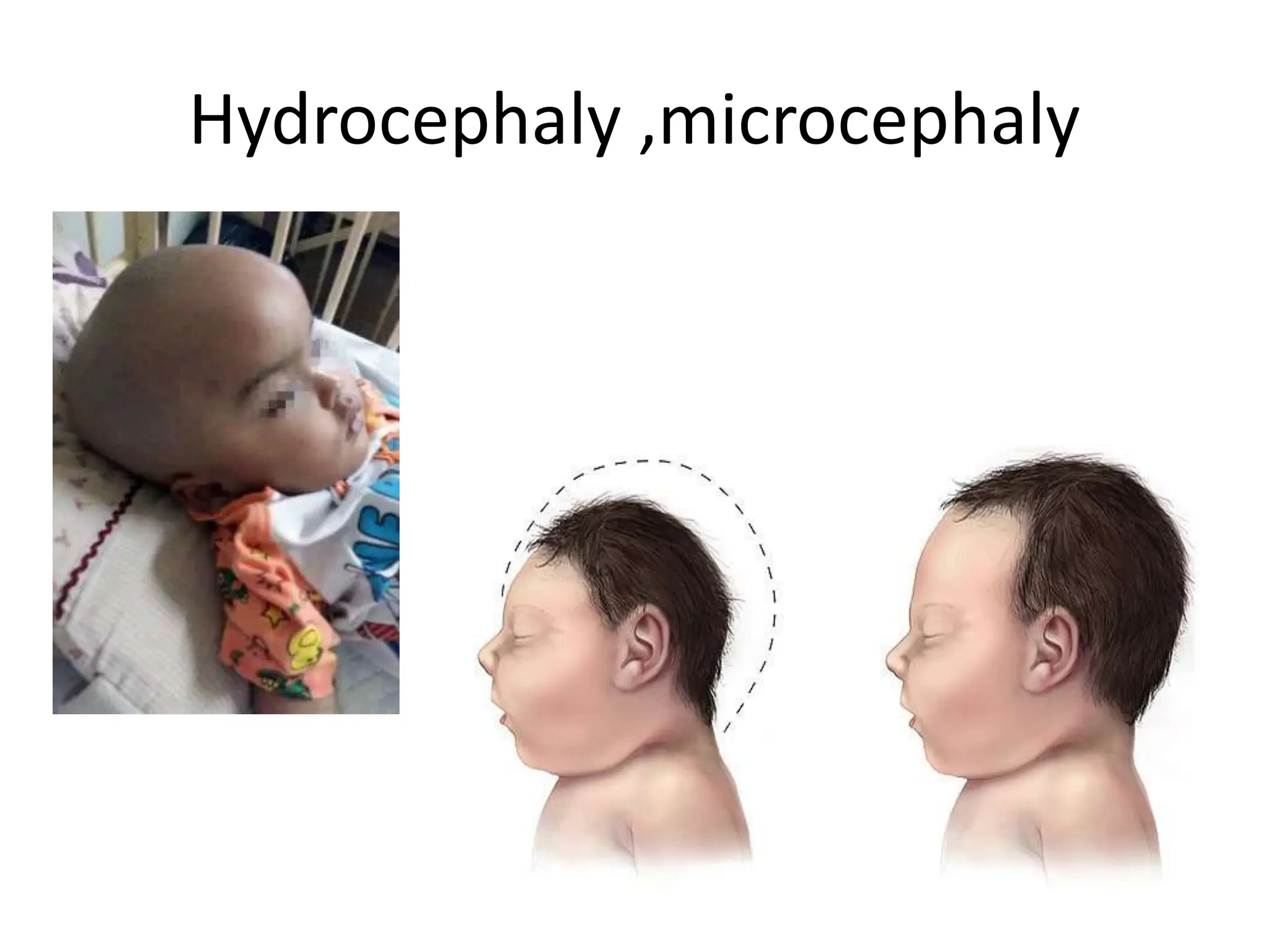 Hydrocephaly ,microcephaly
 