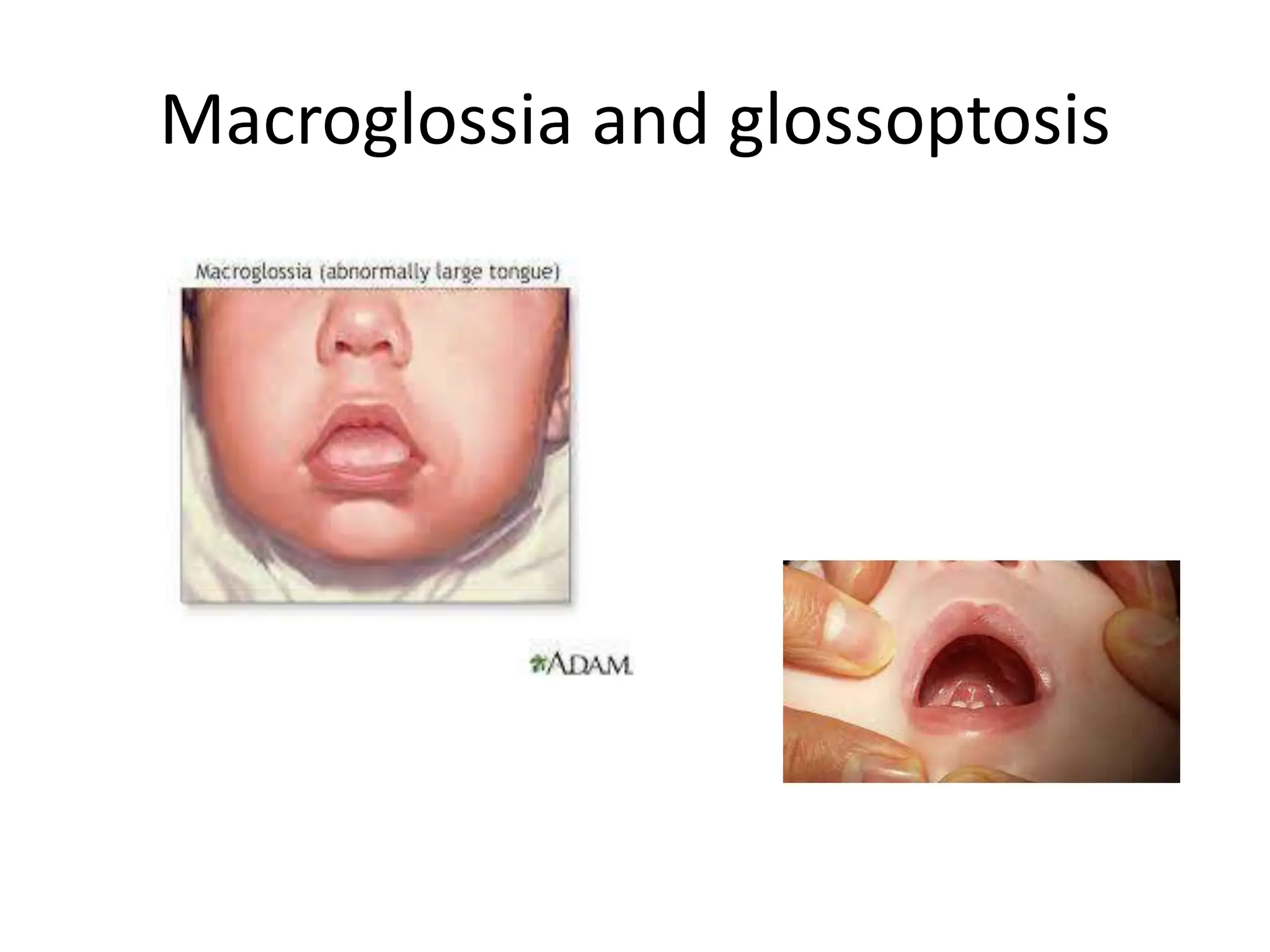 Macroglossia and glossoptosis
 