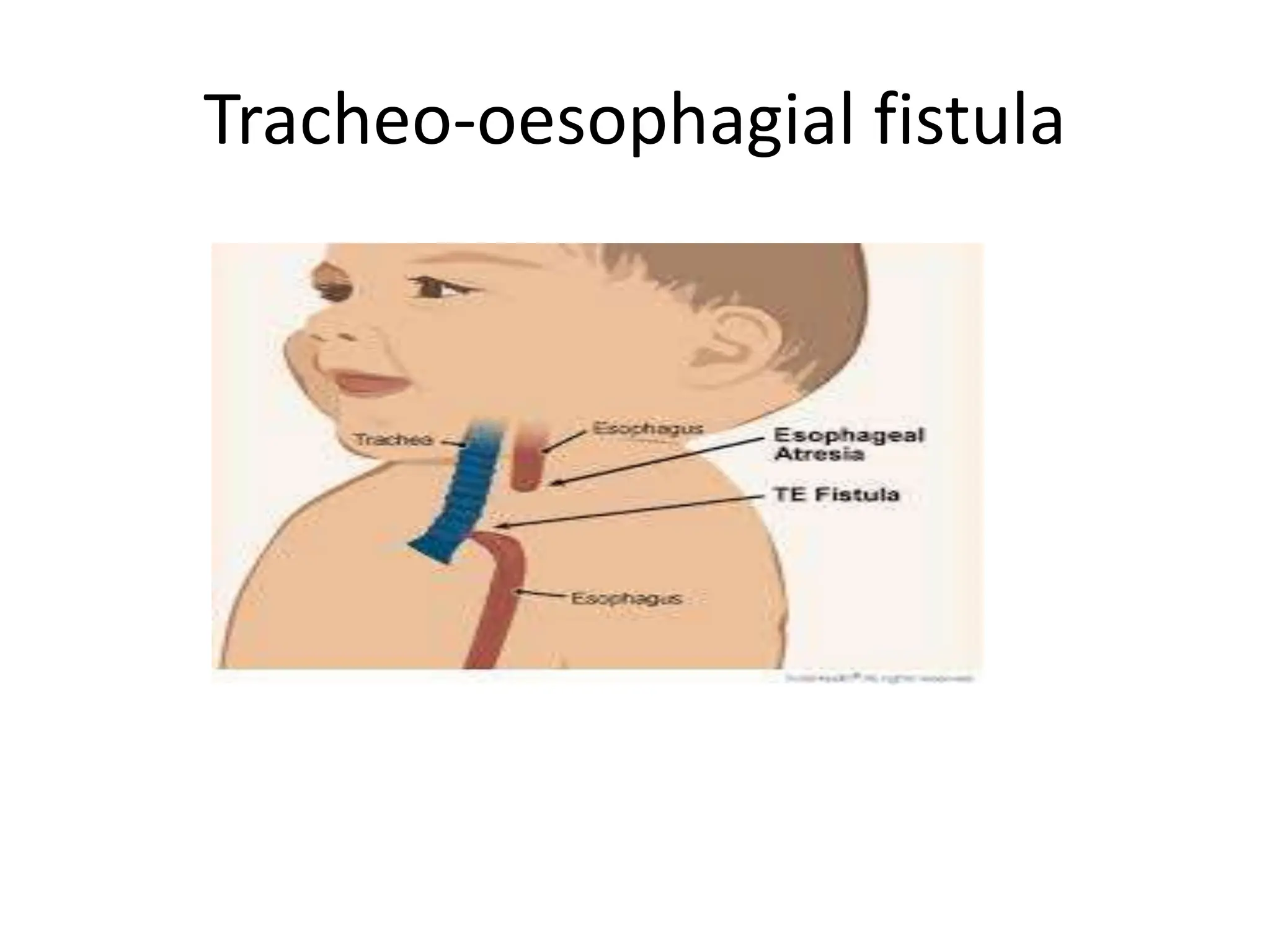 Tracheo-oesophagial fistula
 