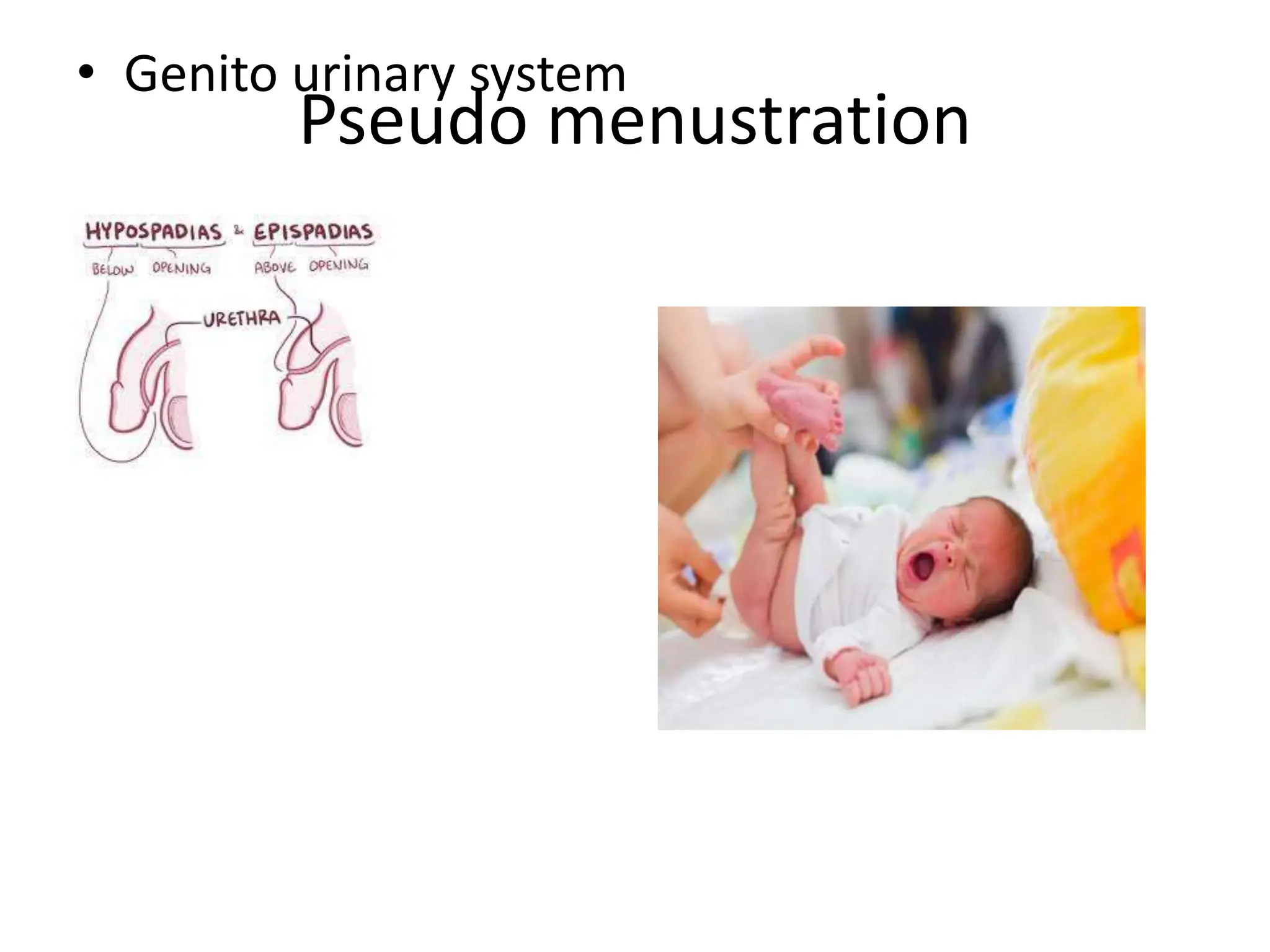 Pseudo menustration
• Genito urinary system
 