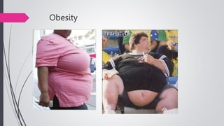 Obesity
 