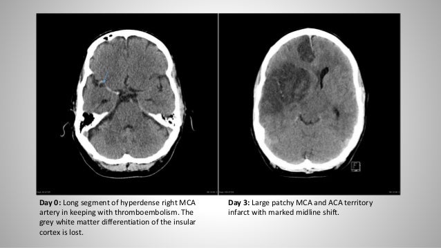 Essentials of CT brain (For Undergraduates)