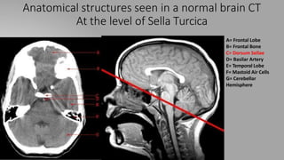 Anatomical structures seen in a normal brain CT
At the level of Sella Turcica
A= Frontal Lobe
B= Frontal Bone
C= Dorsum Sellae
D= Basilar Artery
E= Temporal Lobe
F= Mastoid Air Cells
G= Cerebellar
Hemisphere
 