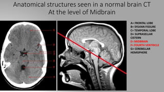Anatomical structures seen in a normal brain CT
At the level of Midbrain
A= FRONTAL LOBE
B= SYLVIAN FISSURE
C= TEMPORAL LOBE
D= SUPRASELLAR
CISTERN
E= MIDBRAIN
F= FOURTH VENTRICLE
G= CEREBELLAR
HEMISPHERE
 