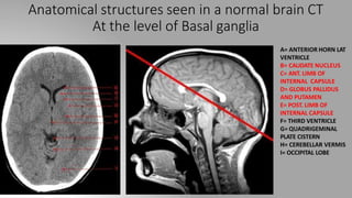 Anatomical structures seen in a normal brain CT
At the level of Basal ganglia
A= ANTERIOR HORN LAT
VENTRICLE
B= CAUDATE NUCLEUS
C= ANT. LIMB OF
INTERNAL CAPSULE
D= GLOBUS PALLIDUS
AND PUTAMEN
E= POST. LIMB OF
INTERNAL CAPSULE
F= THIRD VENTRICLE
G= QUADRIGEMINAL
PLATE CISTERN
H= CEREBELLAR VERMIS
I= OCCIPITAL LOBE
 