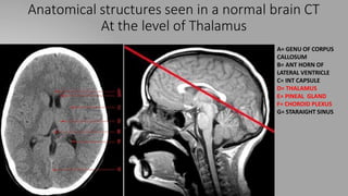 Anatomical structures seen in a normal brain CT
At the level of Thalamus
A= GENU OF CORPUS
CALLOSUM
B= ANT HORN OF
LATERAL VENTRICLE
C= INT CAPSULE
D= THALAMUS
E= PINEAL GLAND
F= CHOROID PLEXUS
G= STARAIGHT SINUS
 
