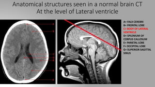 Anatomical structures seen in a normal brain CT
At the level of Lateral ventricle
A= FALX CEREBRI
B= FRONTAL LOBE
C= BODY OF LATERAL
VENTRICLE
D= SPLENIUM OF
CORPUS CALLOSUM
E= PARIETAL LOBE
F= OCCIPITAL LOBE
G= SUPERIOR SAGITTAL
SINUS
 