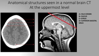 Anatomical structures seen in a normal brain CT
At the uppermost level
A= FALX CEREBRI
B= SULCUS
C= GYRUS
D= SUPERIOR SAGGITAL
SINUS
 