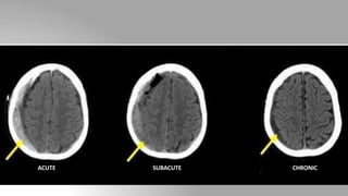 ACUTE SUBACUTE CHRONIC
 