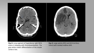 Day 0: Long segment of hyperdense right MCA
artery in keeping with thromboembolism. The
grey white matter differentiation of the insular
cortex is lost.
Day 3: Large patchy MCA and ACA territory
infarct with marked midline shift.
 