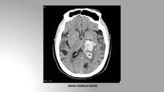 BASAL GANGLIA BLEED
 
