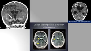Tuberculoma with hydrocephalus
 