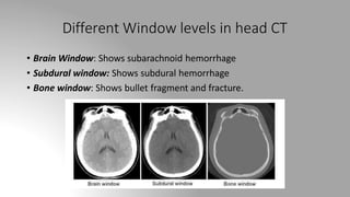 Different Window levels in head CT
• Brain Window: Shows subarachnoid hemorrhage
• Subdural window: Shows subdural hemorrhage
• Bone window: Shows bullet fragment and fracture.
 