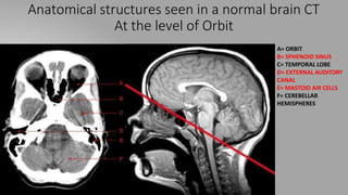 Anatomical structures seen in a normal brain CT
At the level of Orbit
A= ORBIT
B= SPHENOID SINUS
C= TEMPORAL LOBE
D= EXTERNAL AUDITORY
CANAL
E= MASTOID AIR CELLS
F= CEREBELLAR
HEMISPHERES
 