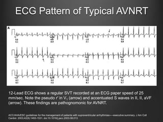 Essentials of ecg interpretation aphrs | PPTX