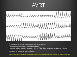 Essentials of ecg interpretation aphrs | PPTX