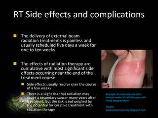 RT Side effects and complications
 The delivery of external beam
radiation treatments is painless and
usually scheduled five days a week for
one to ten weeks
 The effects of radiation therapy are
cumulative with most significant side
effects occurring near the end of the
treatment course.
 Side effects usually resolve over the course
of a few weeks
 There is a slight risk that radiation may
cause a secondary cancer many years after
treatment, but the risk is outweighed by
the potential for curative treatment with
radiation therapy
{Sabin Motwani will
send us image of mild
skin redness after RT
in a treatment field}.
Example of erythroderma after
several weeks of radiotherapy with
moist desquamation
Source:
sarahscancerjourney.blogspot.com
 