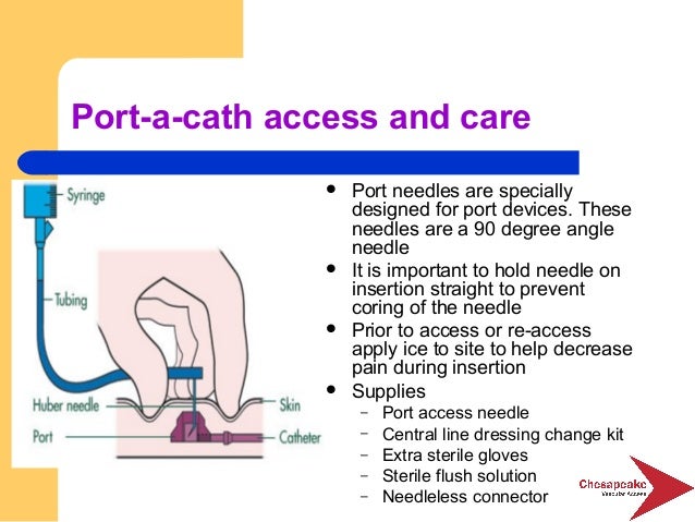 Accessing Port A Cath Steps Portacath A Guide QIWS Accessing Port A Cath Steps Portacath A Guide QIWS