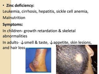 • Zinc deficiency:
Leukemia, cirrhosis, hepatitis, sickle cell anemia,
Malnutrition
Symptoms:
In children- growth retardation & skeletal
abnormalities
In adults- ↓smell & taste, ↓appetite, skin lesions,
and hair loss
19
 