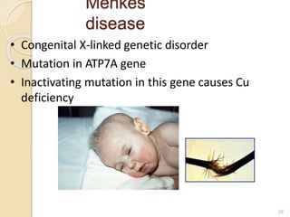 Menkes
disease
26
• Congenital X-linked genetic disorder
• Mutation in ATP7A gene
• Inactivating mutation in this gene causes Cu
deficiency
 