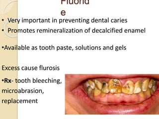 Fluorid
e
• Very important in preventing dental caries
• Promotes remineralization of decalcified enamel
•Available as tooth paste, solutions and gels
Excess cause flurosis
•Rx- tooth bleeching,
microabrasion,
replacement
31
 