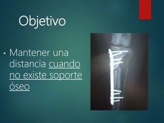 Objetivo
• Mantener una
distancia cuando
no existe soporte
óseo
 