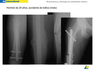 Biomecánica y Biología de estabilidad relativa
Hombre de 29 años, accidente de tráfico (moto)
 