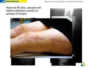 Biomecánica y Biología de estabilidad relativa
Mujer de 58 años, pasajera del
asiento delantero cuando se
produjo el choque.
 