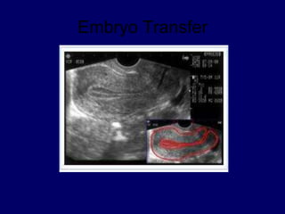 Embryo Transfer
 