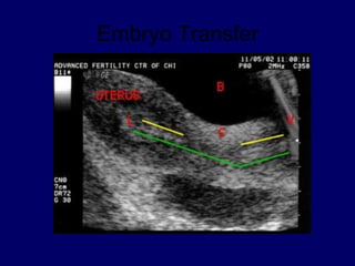 Embryo Transfer
 
